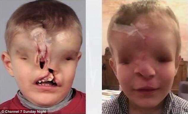 Menino de 3 anos que nasceu completamente desfigurado ganha cirurgia para mudar de vida