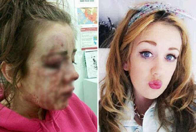 Adolescente de 16 anos fica desfigurada ao ser brutalmente espancada por mãe de colega com quem se desentendeu