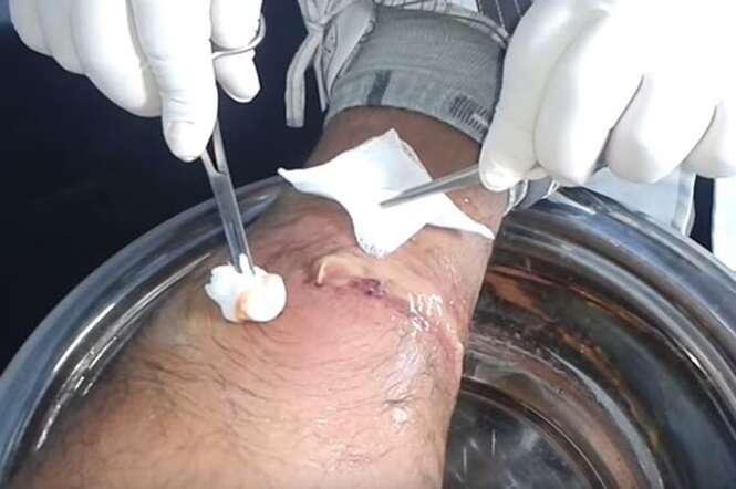 Vídeo nojento mostra momento em que paciente tem pus drenado de sua perna